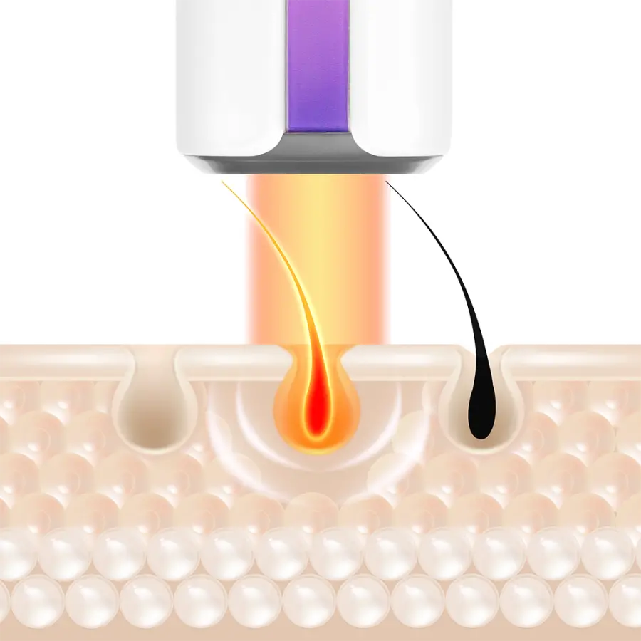 Yamaguchi IPL Hair Removal